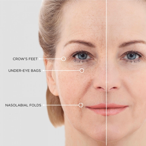 beautical microneedle eye patches anti-wrinkle anti-aging moisturizing