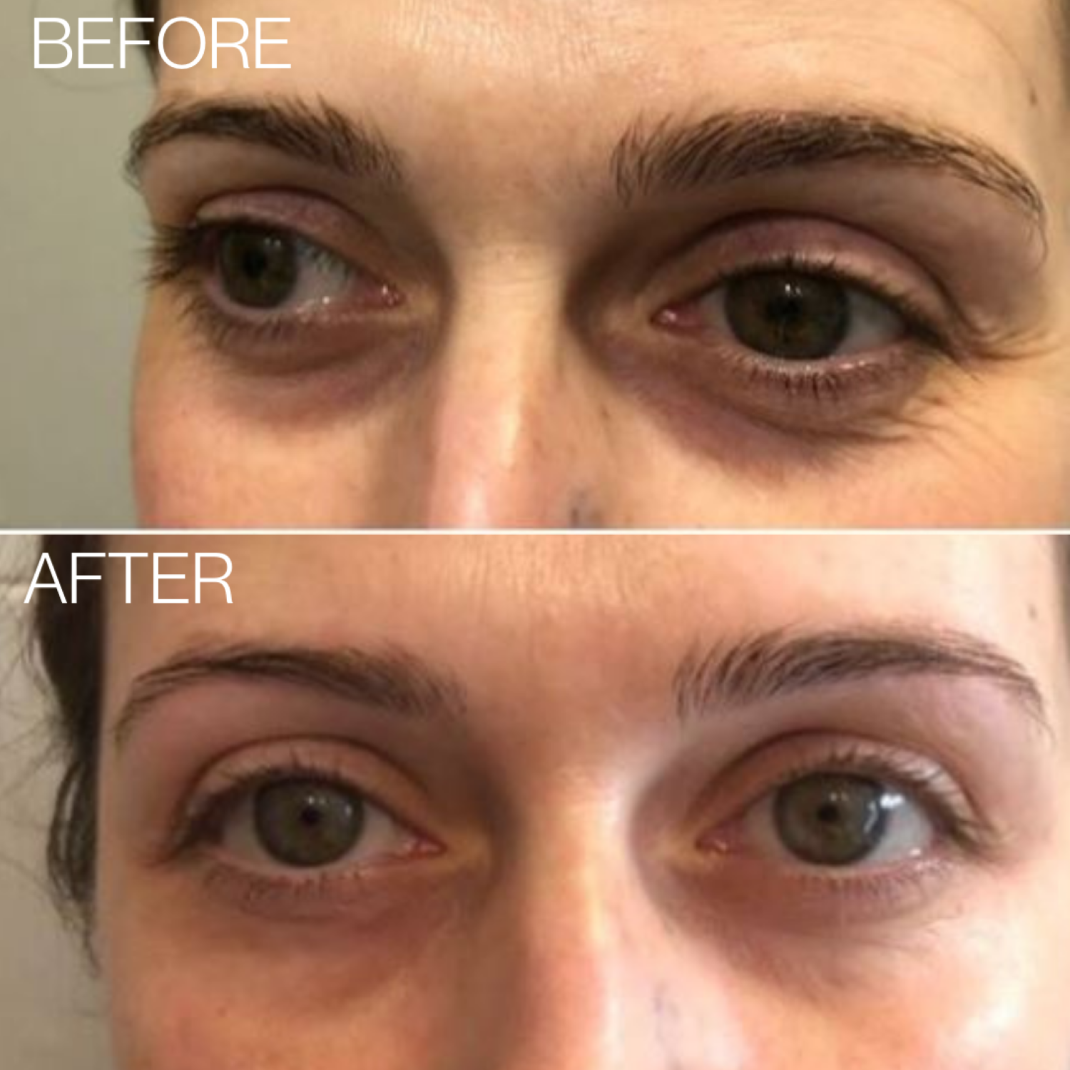 BEAUTICAL Microneedle Eye Patches before-after BEAUTICAL Microneedle Eye Patches before-after