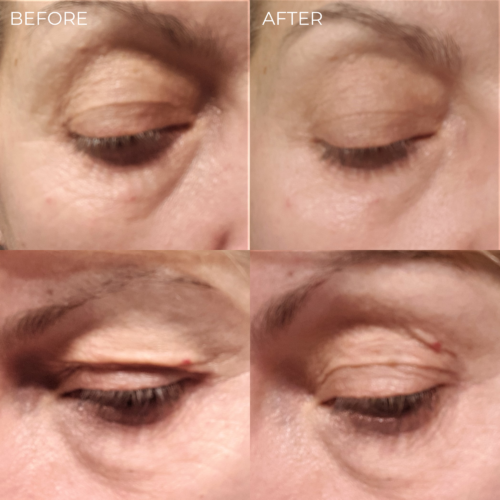BEAUTICAL Instant Lifting Serum before after